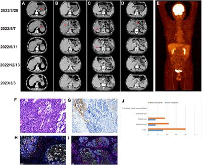 Favorable response to PD-1 inhibitor plus chemotherapy as first-line treatment for metastatic gastric mixed neuroendocrine-non-neuroendocrine tumor: a case report